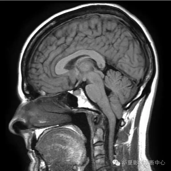 畸形|這 6 種典型影像征象的病變你都認識了嗎