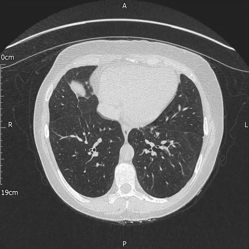大叶性肺叶图片图片