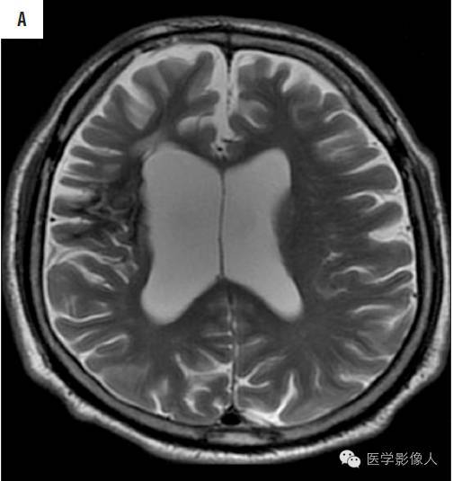 黄素环|脑内T2WI上低信号病变大致分为8大类【总结】