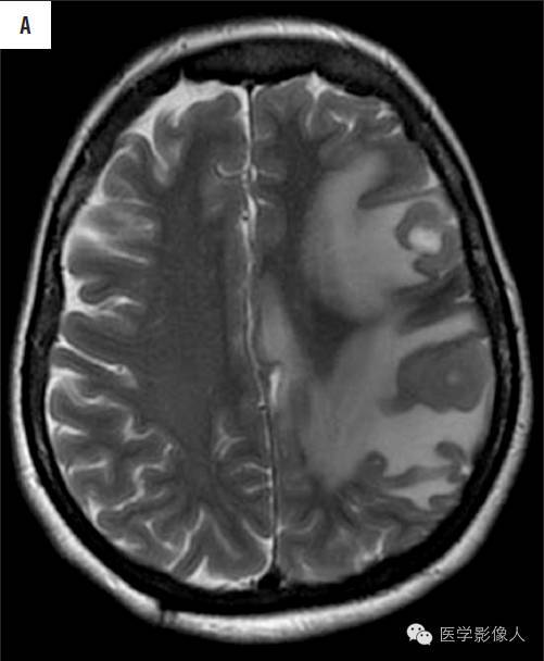 黄素环|脑内T2WI上低信号病变大致分为8大类【总结】