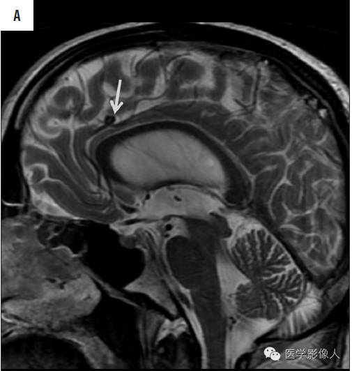 黄素环|脑内T2WI上低信号病变大致分为8大类【总结】