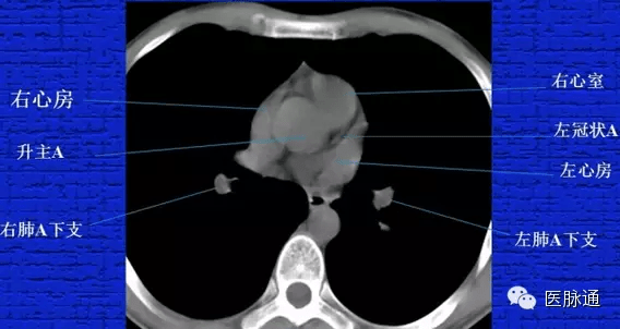 胸部正常ct解剖結構