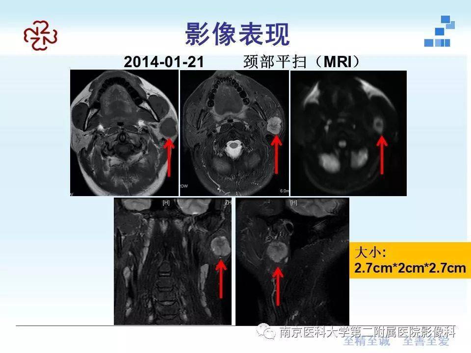 腮腺ct图图片