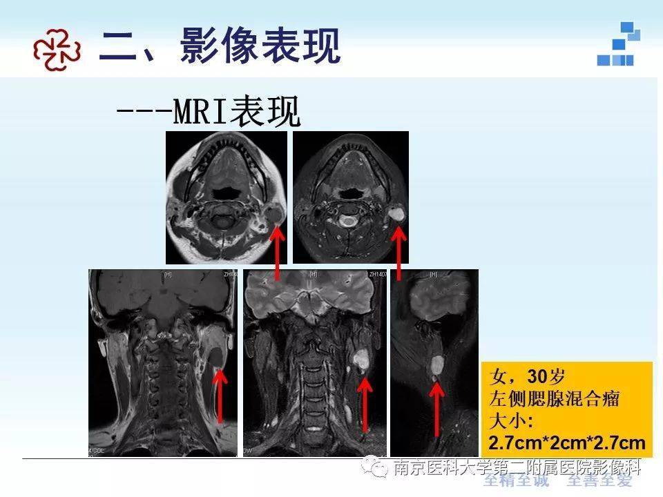 腮腺混合瘤的影像診斷與鑑別