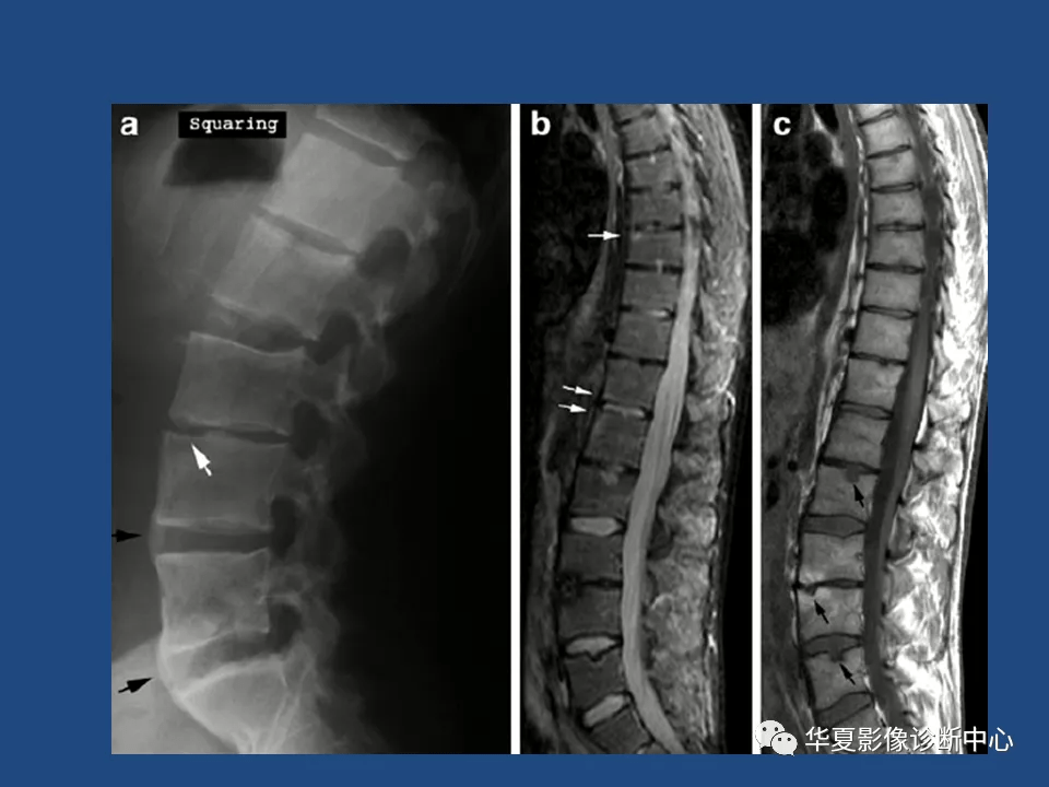强直性脊柱炎影像诊断和鉴别诊断