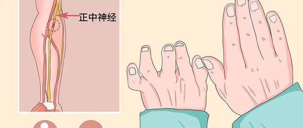 猿手畸形_神经