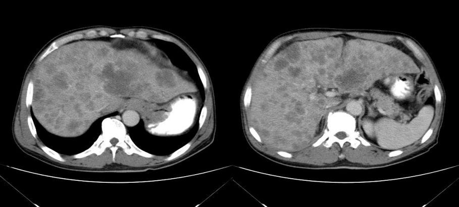 一例her2晚期胃癌肝转移病例的介入联合靶向治疗过程丨抗her之路 与妮