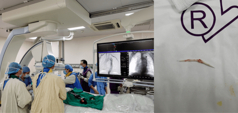 耳鼻|鱼刺卡喉，吞了口饭险夺命！医生提醒→