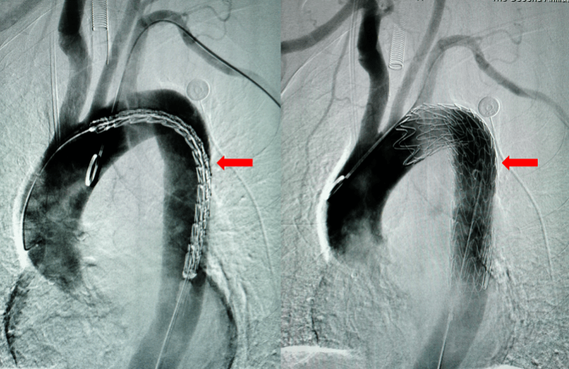 耳鼻|鱼刺卡喉，吞了口饭险夺命！医生提醒→