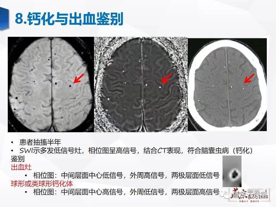 大咖讲堂 | 磁敏感加权成像(swi) 原理及临床应用
