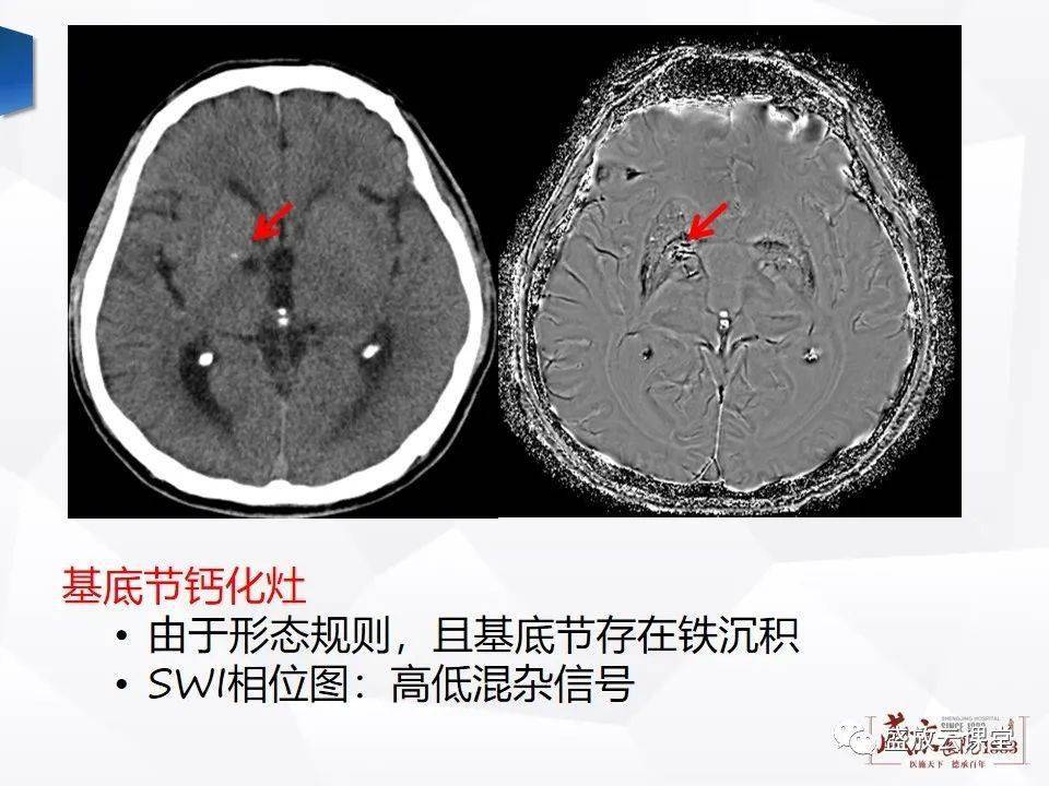 大咖讲堂 | 磁敏感加权成像(swi) 原理及临床应用