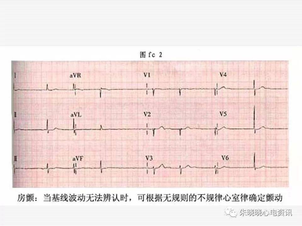 心電圖危急值識別與診斷