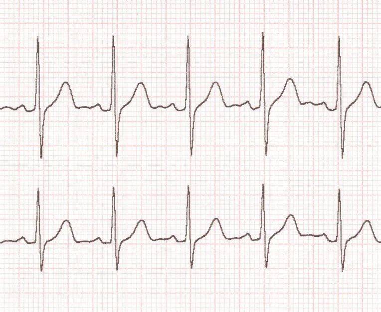症状|心源性猝死屡屡发生，这些关于猝死的知识你需要知道