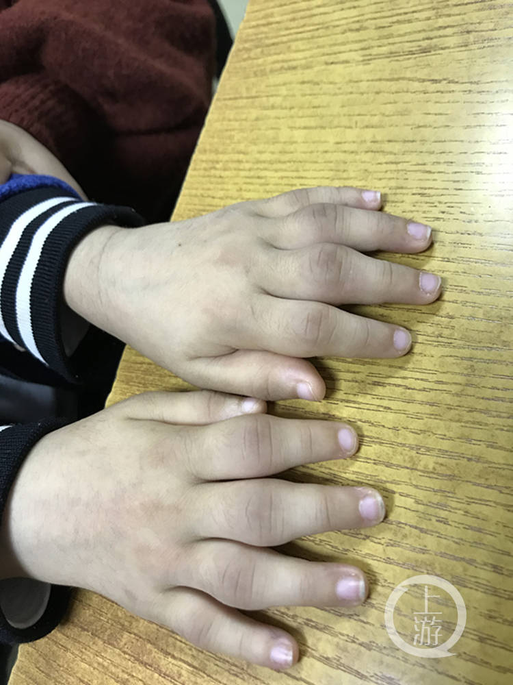 儿童手指中间关节粗大图片