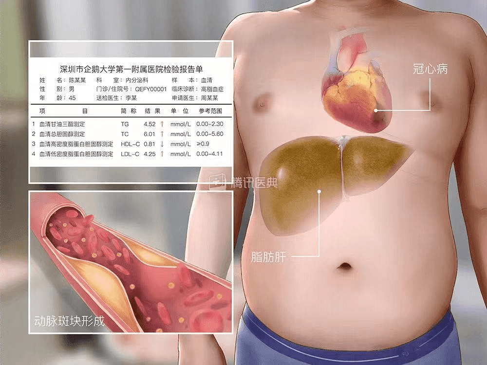 血管|化验单上没有上下箭头，血脂就达标了吗？