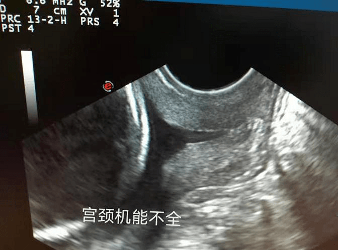 妇科超声检查选择经腹好还是经腔内好