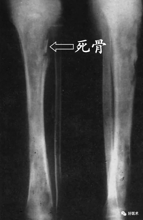 110张经典x线片影像诊断夜班医生必备