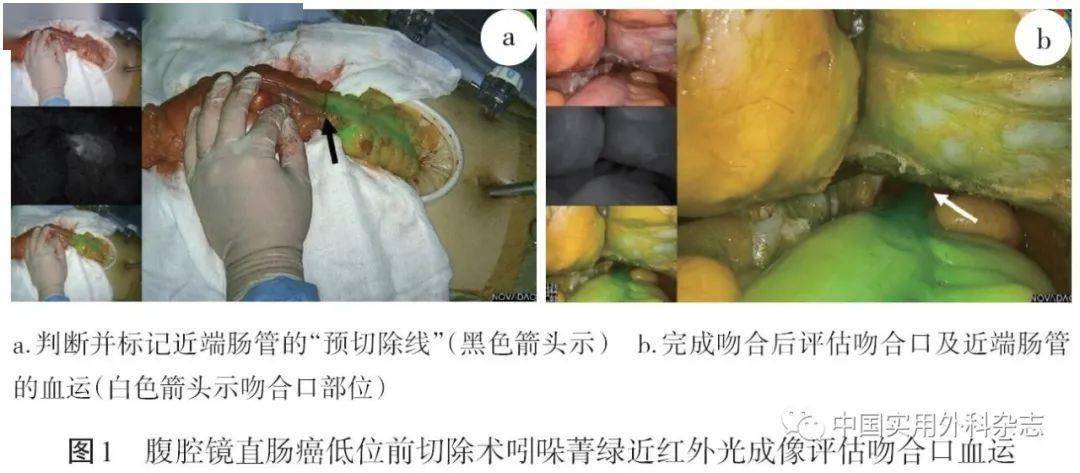吲哚菁绿近红外光成像在腹腔镜结直肠癌手术中应用中国专家共识2021