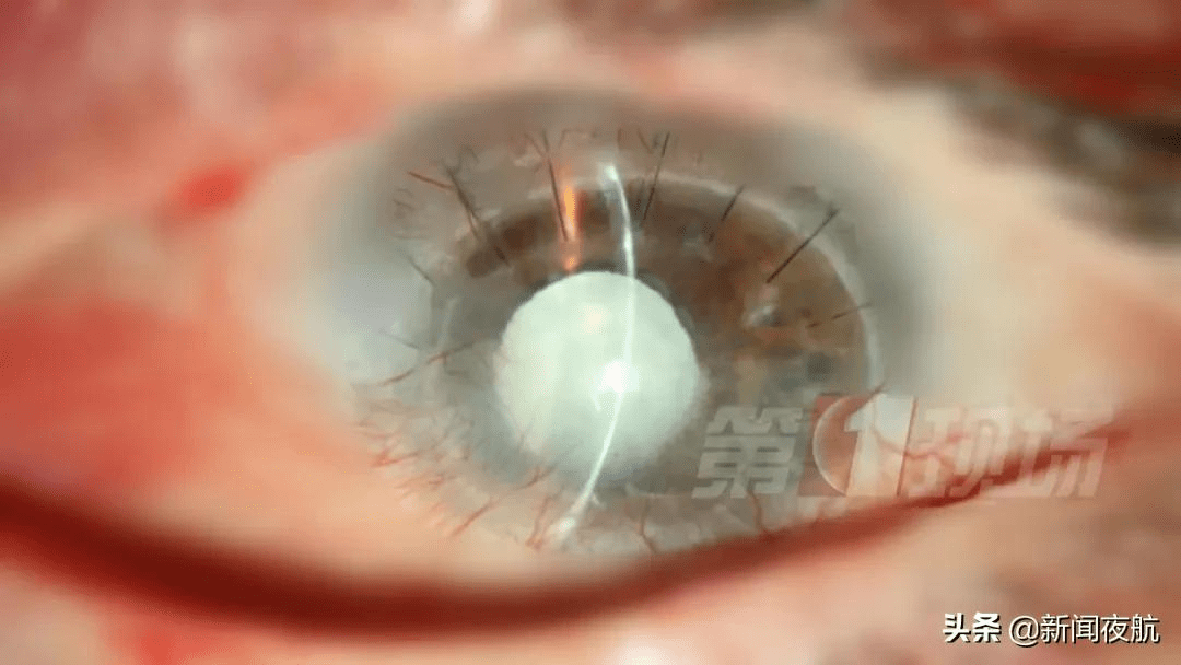 视网膜|女生摸黑玩手机瞳孔变白，视网膜脱落！这个习惯你还在坚持吗？