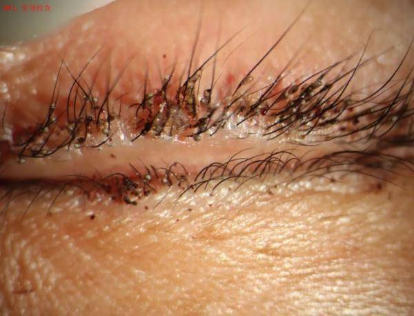 女子|杭州一女子双眼瘙痒难忍，医生都惊呆了