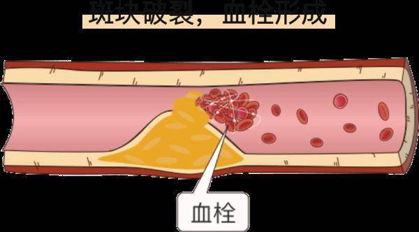 感觉|它是心梗、脑梗的元凶，更容易找上这些人