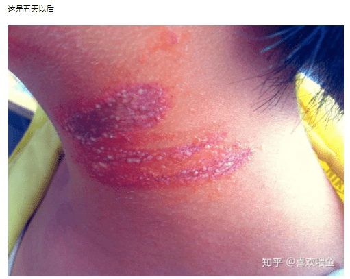 不少网友都表示被隐翅虫叮咬过,热搜话题下,就医后确诊为隐翅虫皮炎她