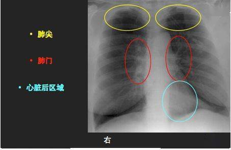 ②肋膈角(或肋膈隱窩)代表的是髒層胸膜和壁層胸膜之間的潛在間隙,該