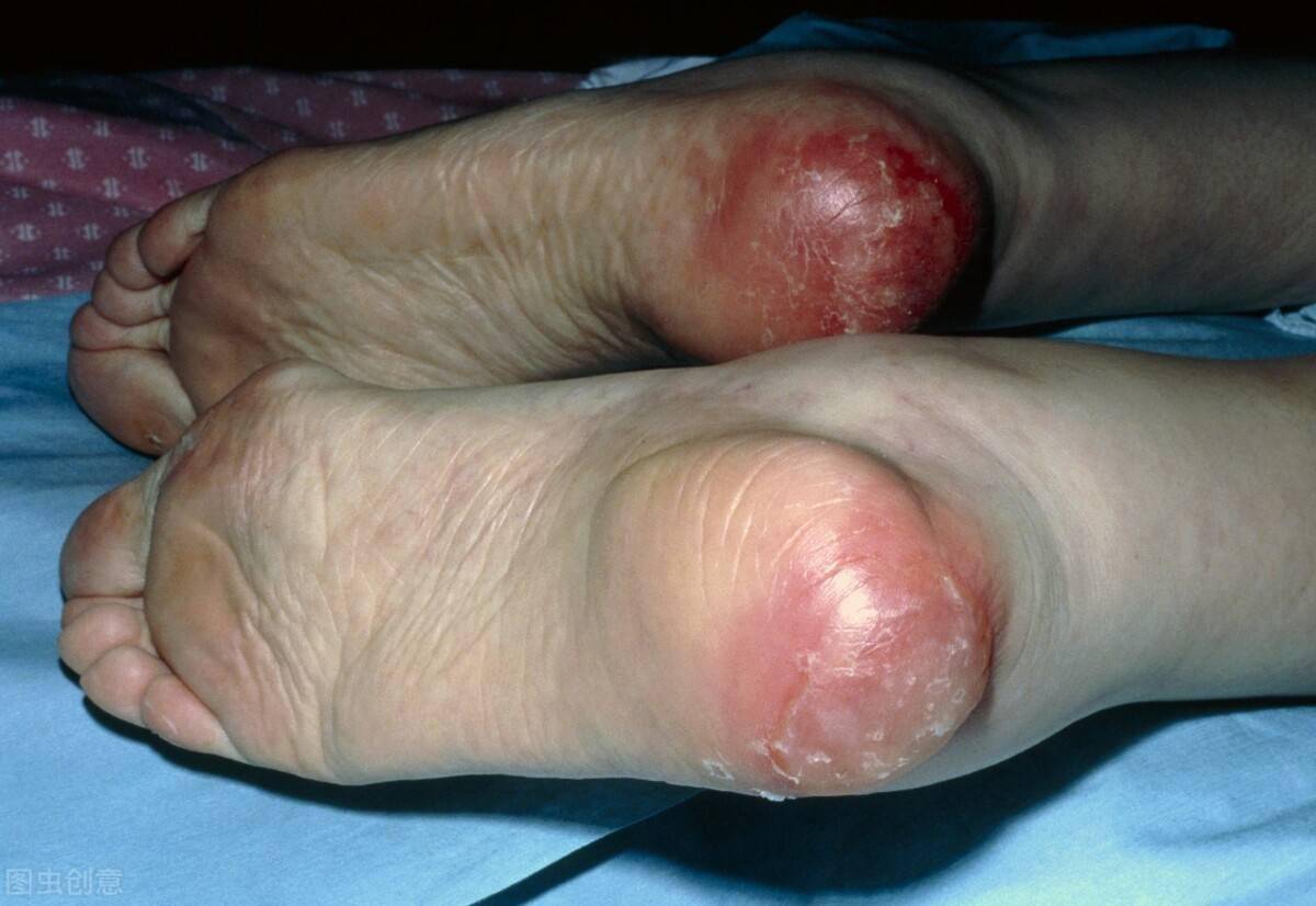 疗效〕各种疖毒,疔疮,褥疮等皮肤病〔功用〕 〔主治〕每天涂一次.