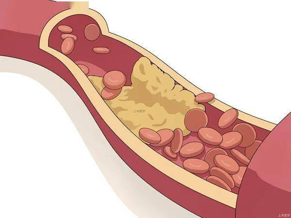 簡單講就是血脂太高了,形成了斑塊, 把心臟血管堵得變窄了