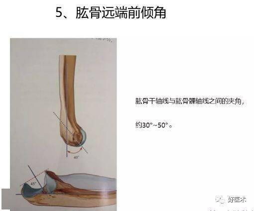 翼应该对准结节间沟后方,假体内,外旋达到50°关节稳定说明后倾角合适