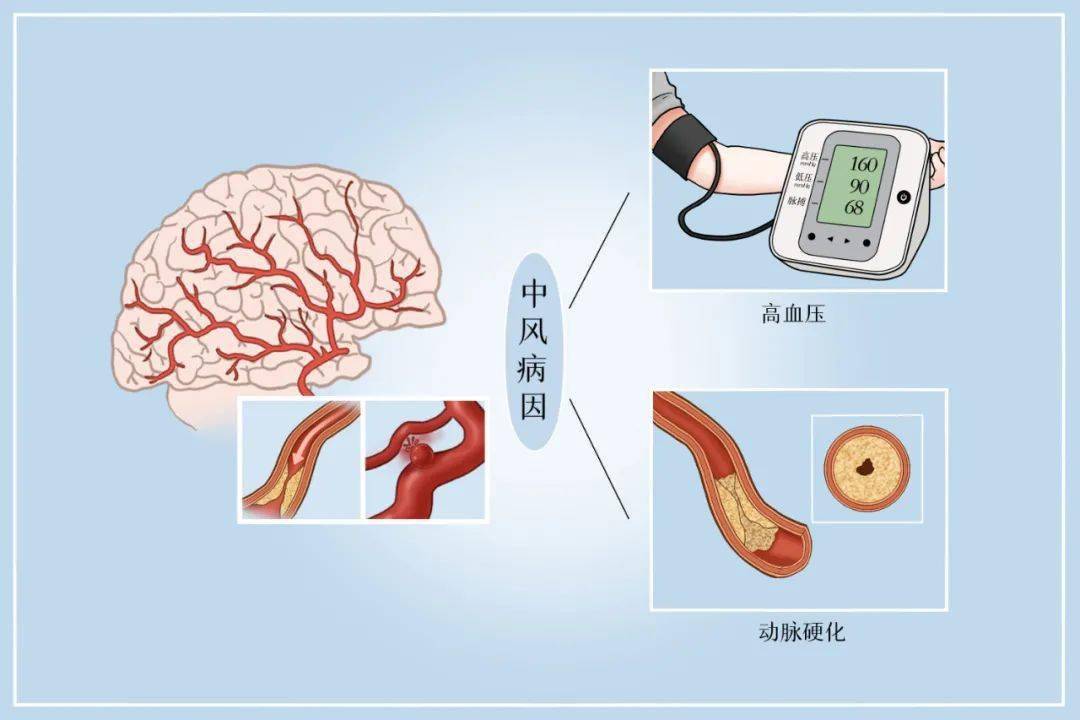 警惕卒中症状尽早识别救治记住口诀befast