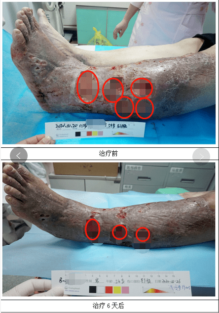 糖尿病性大疱病图片