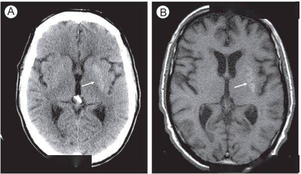 进行|脑出血CT的9大“陷阱”，稍不留神就会误诊