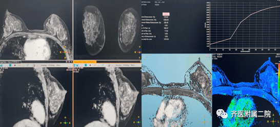 乳腺磁共振成像六,血管方面應用可以採用注射造影劑血管成像,也可以