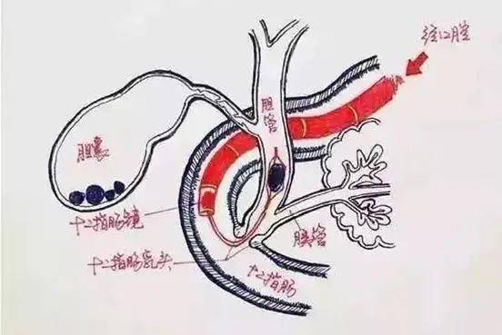 不开刀取结石,ercp是什么?