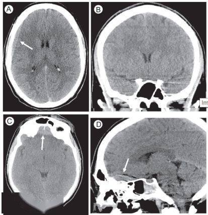 脑干出血的ct片子图片图片