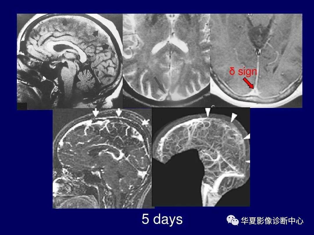 诊断|缺血性脑血管病的影像诊断