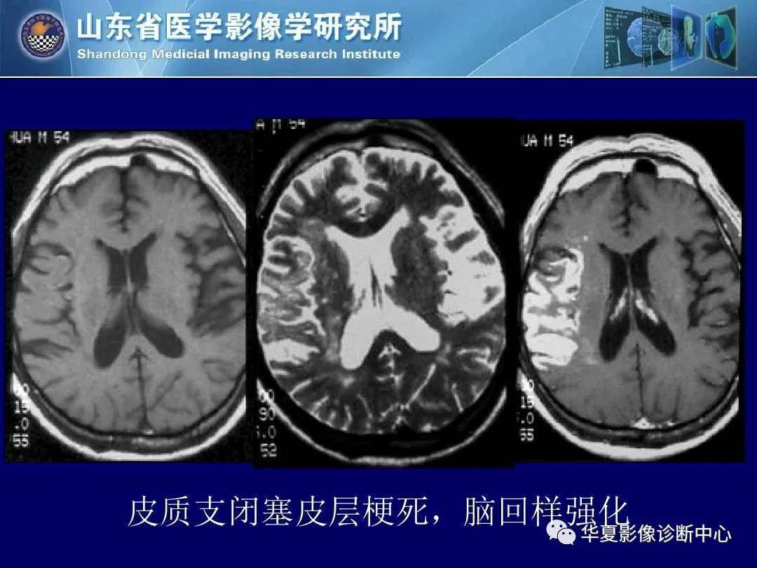 诊断|缺血性脑血管病的影像诊断