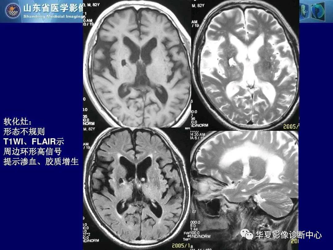 诊断|缺血性脑血管病的影像诊断