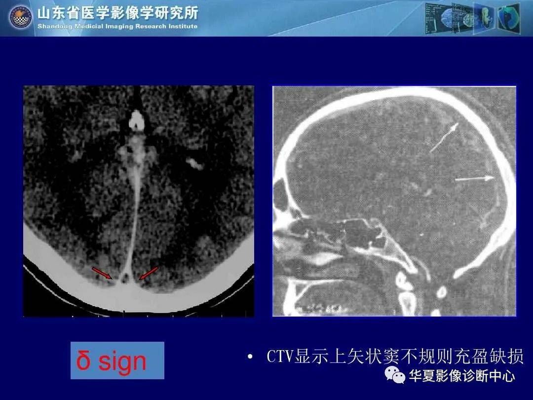 诊断|缺血性脑血管病的影像诊断