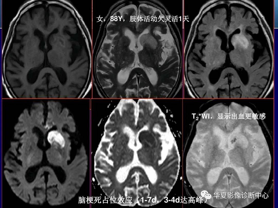 诊断|缺血性脑血管病的影像诊断