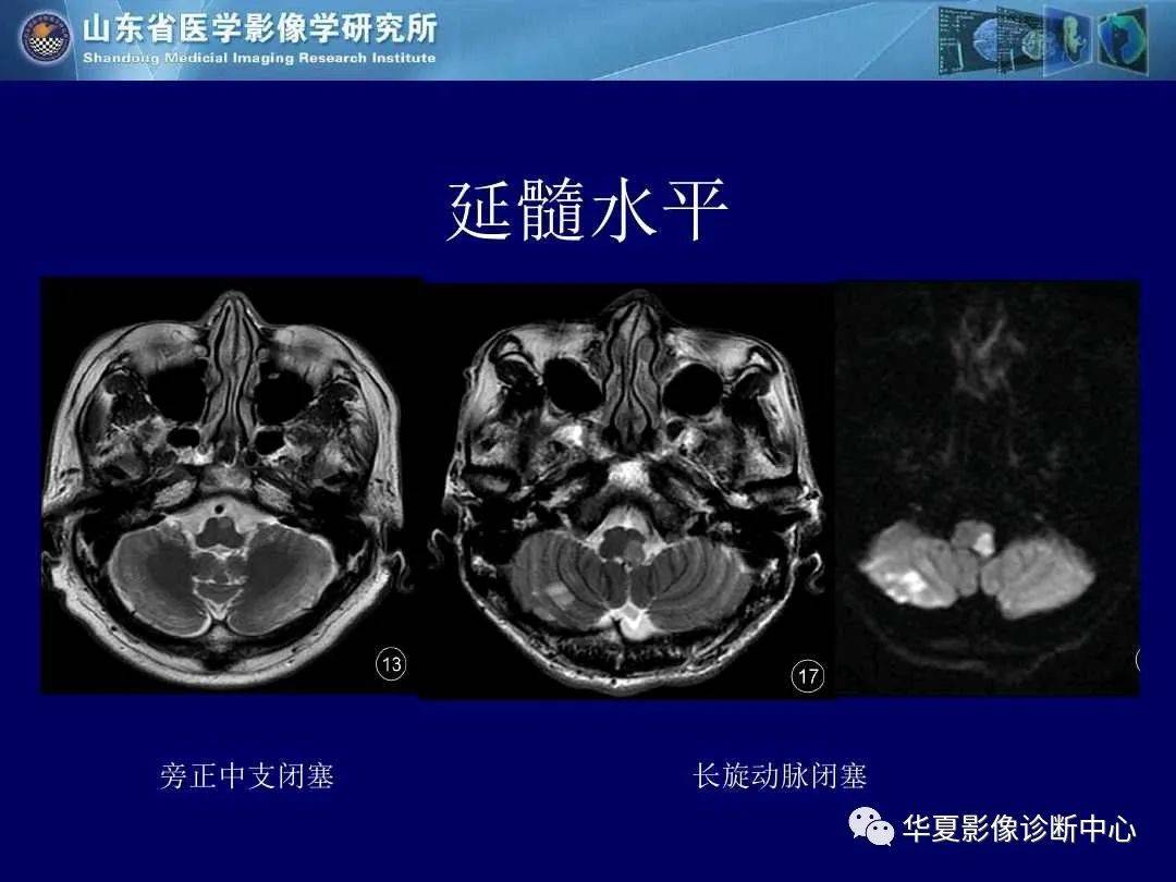 诊断|缺血性脑血管病的影像诊断