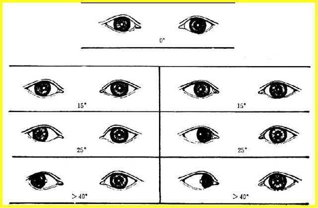 眼位检查角膜映光法和遮盖试验