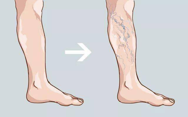 血栓|一时跷二郎腿一时爽，一直跷二郎腿一直爽！