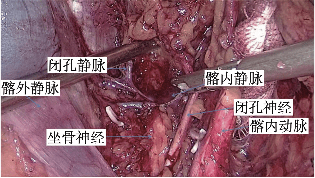 側方淋巴結轉移主要通過前方(前列腺膀胱),側方(直腸中動脈)及後方(骶