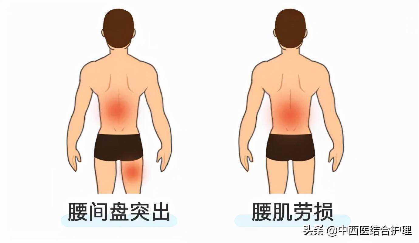 腰间盘突出:主要疼痛部位是腰部中间,压痛时可出现下肢放射痛.