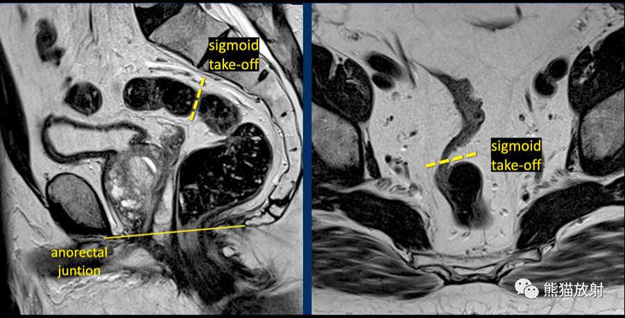 "sigmoid take-off"是基于解剖学的直肠乙状结肠连接部(rectosigmoid
