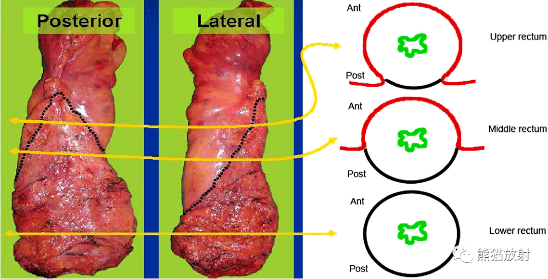 直腸大體病理標本&環周切緣crm(黑線)和直腸腹膜部分(紅線)之間關係的