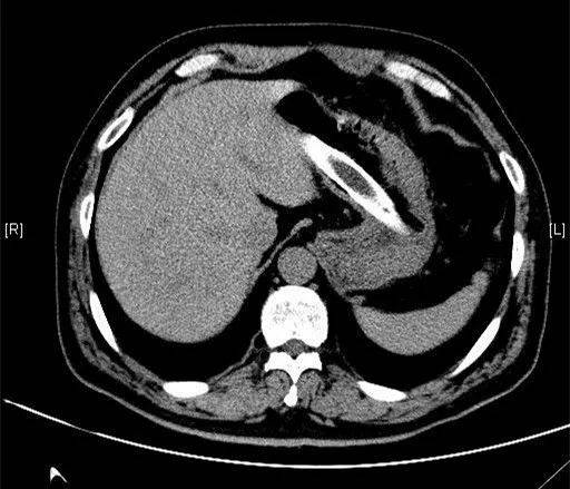 男子|男子胃里取出衣架、塑料管！在肚里待了3个月