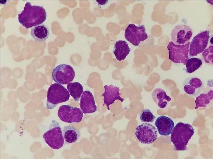 弥漫大b细胞淋巴瘤